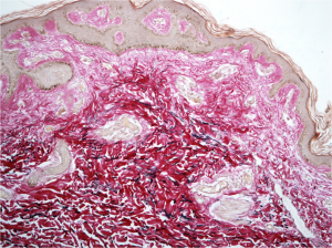 sezione di cute con derma invaso da collagene glicato